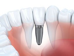 Dental Implants
